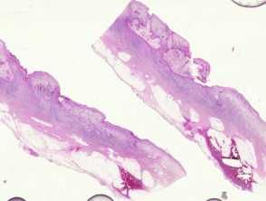 Patología de pioderma similar a blastomicosis