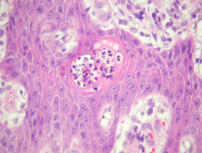 Patología de pioderma similar a blastomicosis