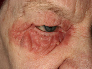 Blefaritis asociada a dermatitis seborreica