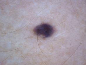 Nevus azul, tipo de piel 2, dermatoscopia
