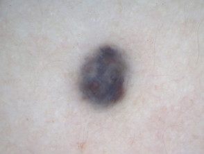 Nevus azul, dermatoscopia de piel tipo 1