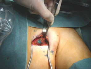 Se observa tinte en el ganglio linfático durante la biopsia del ganglio centinela