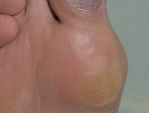 Síndrome del dedo del pie azul: isquemia