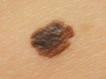 El melanoma tiene un borde con muescas