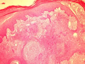 Botryomycose pathologie