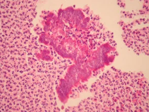 Botryomycose pathologie