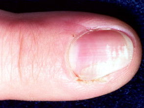 Malattia di Bowen delle unghie