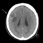 Tomografía computarizada del cerebro con metástasis de melanoma