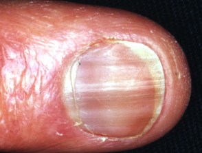 Pigmentación de las uñas por hidroxiurea