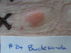 Patch test Budesonide positivo