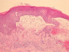 Pathologie van bulleus pemfigoïd