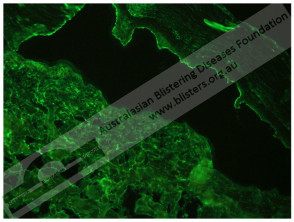 Inmunofluorescencia indirecta del penfigoide bulloso