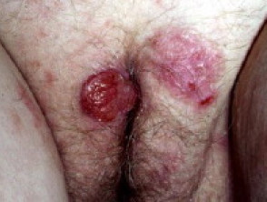 Carcinoma de células basales y escamosas de vulva