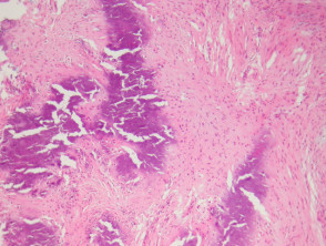 Patología calcificante del fibroma aponeurótico