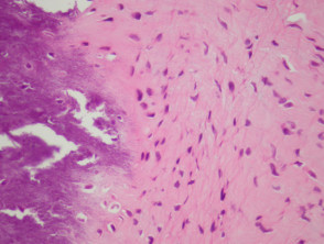 Patología calcificante del fibroma aponeurótico