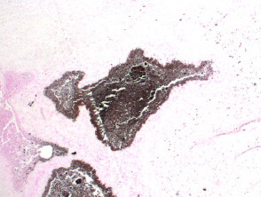 calcinosis cutis von Kossa tinción de plata