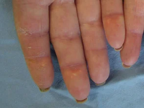 Dermatomiosite della mano 