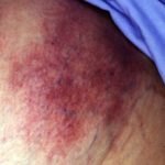 calciphylaxis1__protectwyjqcm90zwn0il0_focusfillwzi5ncwymjisingildfd-9083589-2350372-jpg-4571134