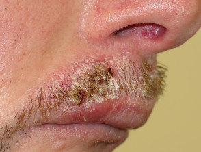 Candida albicans de bigote