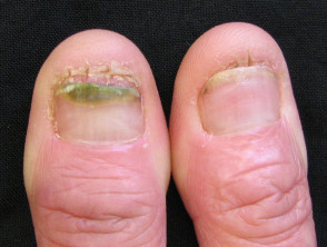 Infección ocupacional de uñas candida