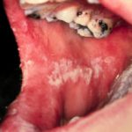 candida-stomatitis__protectwyjqcm90zwn0il0_focusfillwzi5ncwymjisingildfd-3514200-3589831-jpg-7121601