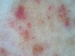 Dermatoscopia de capillariti