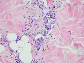 Carcinoma erisipeloide