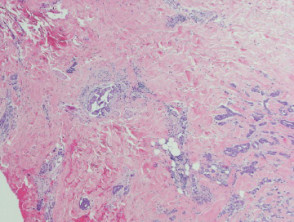 Carcinoma erisipeloide