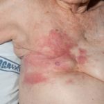 carcinoma-erysipeloides1__protectwyjqcm90zwn0il0_focusfillwzi5ncwymjisingildhd-3135581-9026498-jpg-7373128