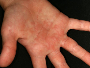 Irritación de manos por contacto con orugas.