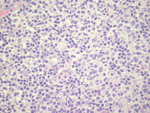 Patología cutánea del linfoma de células T pleomórficas pequeñas y medianas