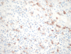 Patología del linfoma cutáneo de células T pleomórficas pequeñas y medianas
