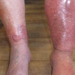 cellulitis-001__protectwyjqcm90zwn0il0_focusfillwzi5ncwymjisinkildg1xq-3664207-7820509-jpg-8380201