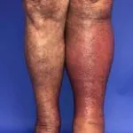 cellulitis-012__protectwyjqcm90zwn0il0_focusfillwzi5ncwymjisinkildg1xq-6110054-5799259-jpg-6958653