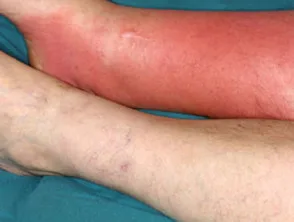 Cellulitis