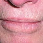 cheilitis1__protectwyjqcm90zwn0il0_focusfillwzi5ncwymjisingildfd-2054664-2508188-jpg-4762786
