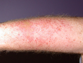 Dermatitis de contacto irritante aguda