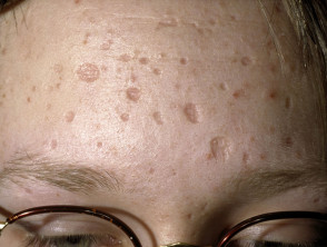 Cicatrices de varicela