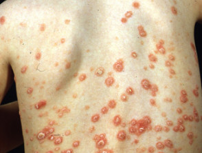 kinder-psoriasis-1__protectwyjqcm90zwn0il0_focusfillwzi5ncwymjisinkildewnl0-9901740-1792131-jpg-6618073