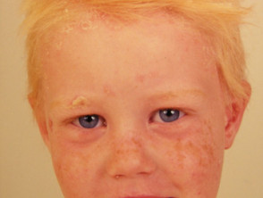 Psoriasis facial en niños