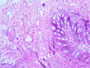 Pathologie van cholesterolembolie