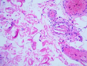 Pathologie van cholesterolembolie