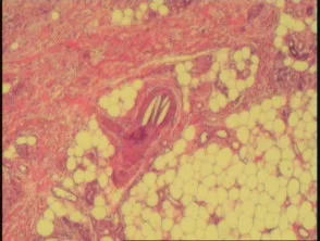 Pathologie van cholesterolembolie