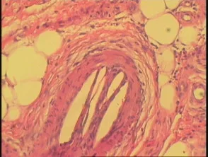 Pathologie van cholesterolembolie