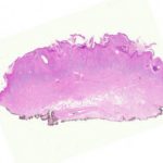 chromoblastomycosis-figure-1__protectwyjqcm90zwn0il0_focusfillwzi5ncwymjisinkilde3xq-1058019-1108027-jpg-4713003