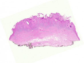 chromoblastomycosis-figure-1__protectwyjqcm90zwn0il0_focusfillwzi5ncwymjisinkilde3xq-1058019-1108027-jpg-4713003