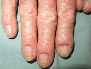 Paroniquia crónica y dermatitis de manos
