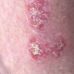chronische Plaque-Psoriasis-001__protectwyjqcm90zwn0il0_focusfillwzi5ncwymjisinkildg1xq-7576254-9184250-jpg-8307775