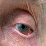 cicatricial-pemphigoid-017__protectwyjqcm90zwn0il0_focusfillwzi5ncwymjisingildfd-6331682-1134424-jpg-7609099