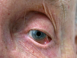 Penfigoide cicatricial ocular